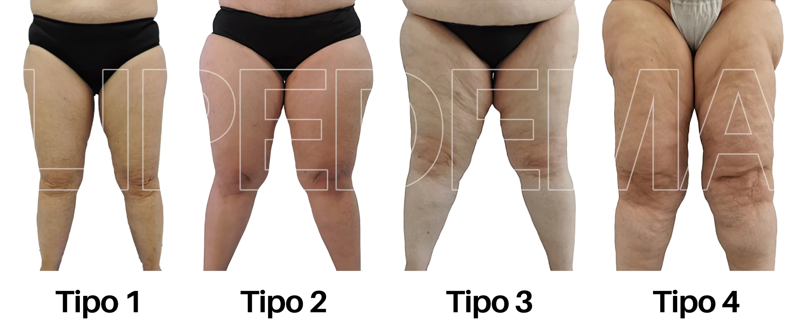 Lipedema vs Celulitis