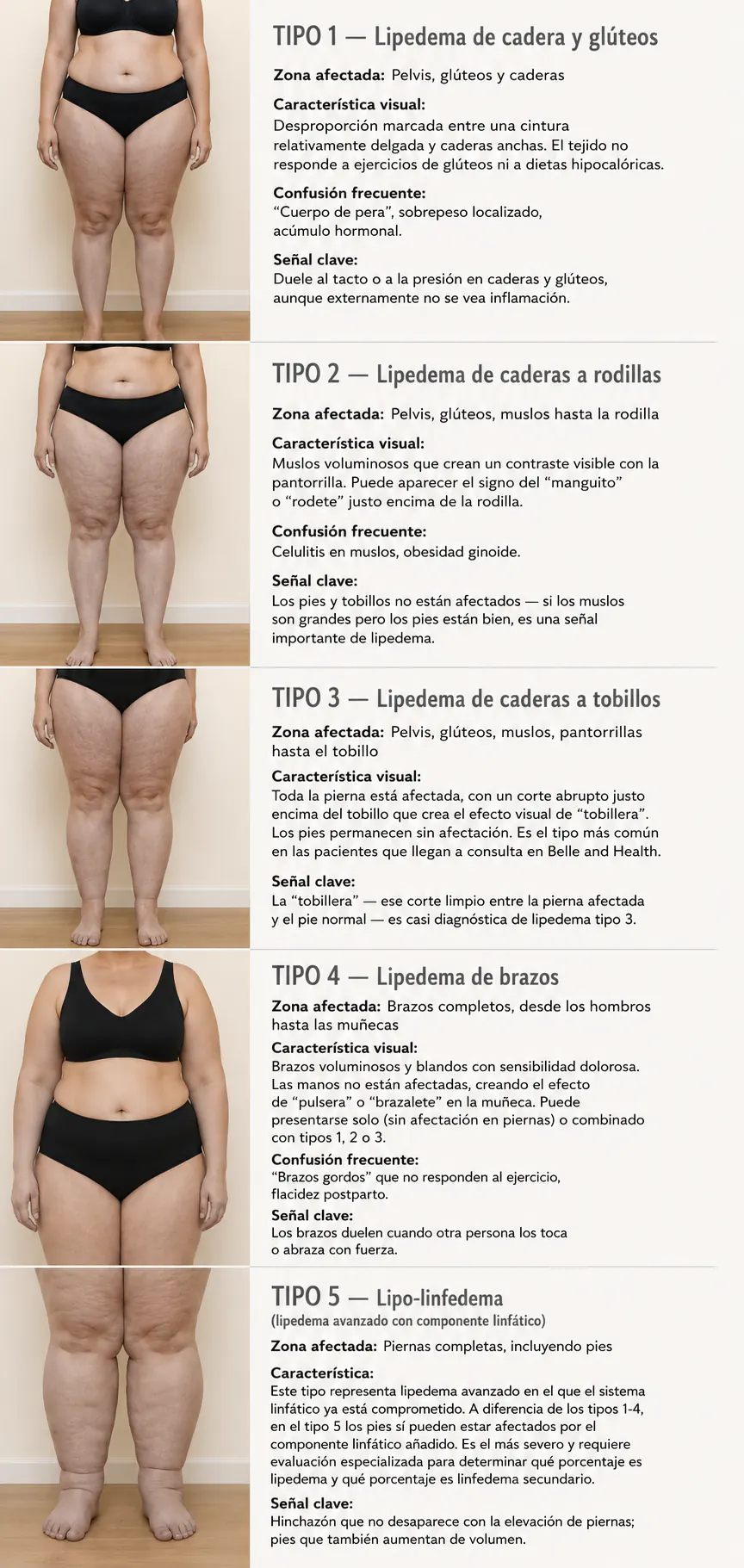 Típos de Lipedema